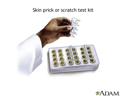 scratch test definition science|allergy skin testing chart.